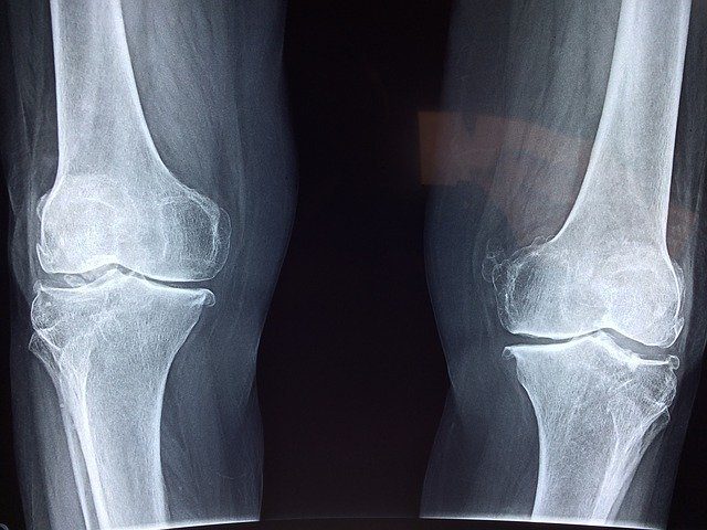 knee xray showing injury