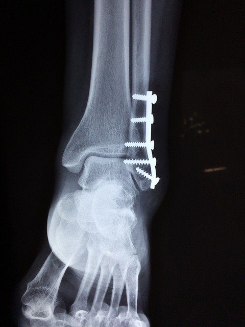 ankle injury